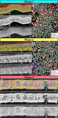 Current perspective on retinal remodeling: Implications for therapeutics